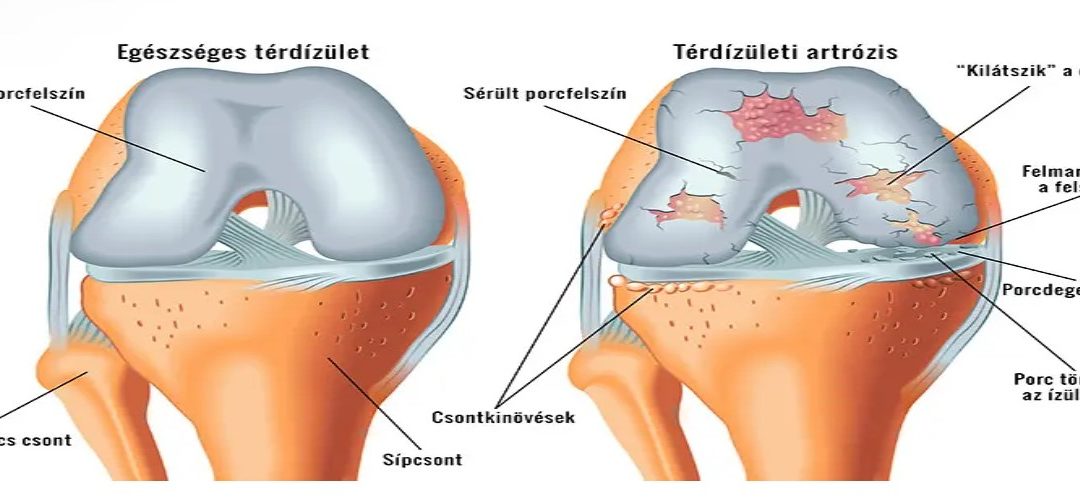 A térd artrózisa enyhíti a fájdalmat