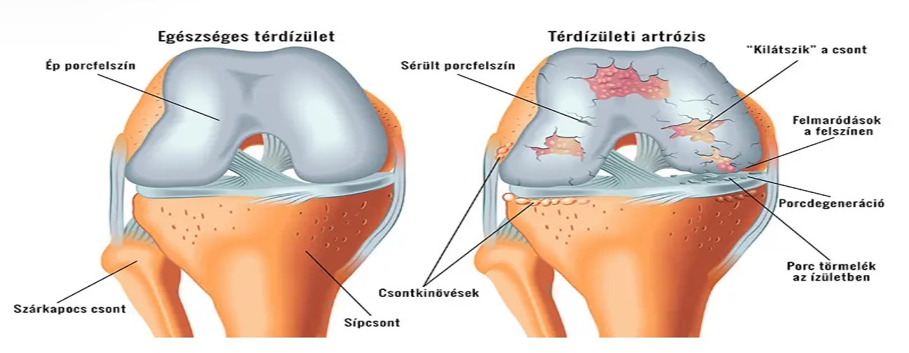 a térd artrózisa enyhíti az akut fájdalmat